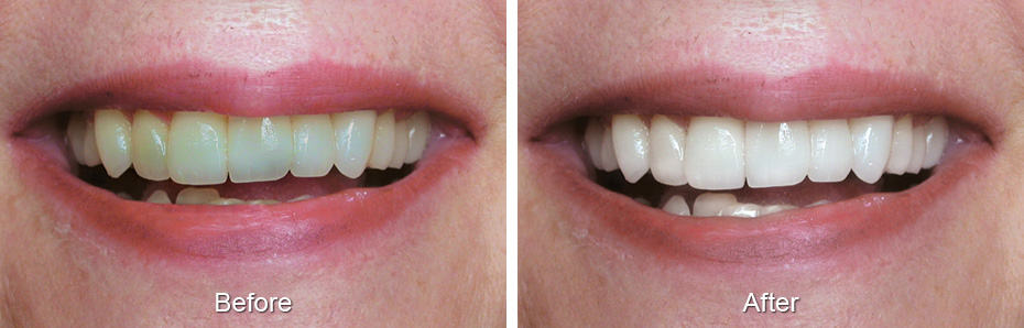 Smile before and after treatment: discolored, uneven front teeth, then a brighter, even smile