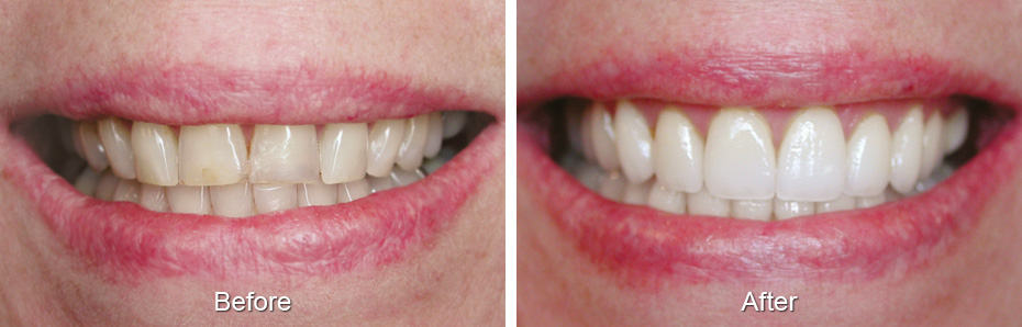 Smile before and after treatment: yellowed, crowded teeth, then whiter, evenly shaped teeth