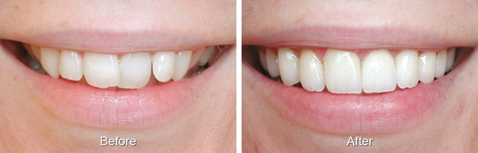 Smile before and after treatment: worn, uneven front teeth, then a whiter, more even smile