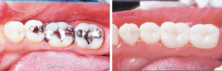 Back teeth before and after treatment: dark metal fillings replaced with tooth-colored restorations