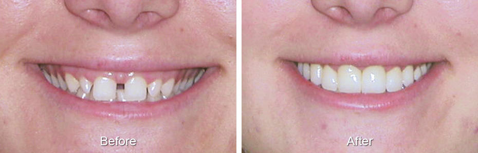 Smile before and after treatment: a gap between the front teeth closed